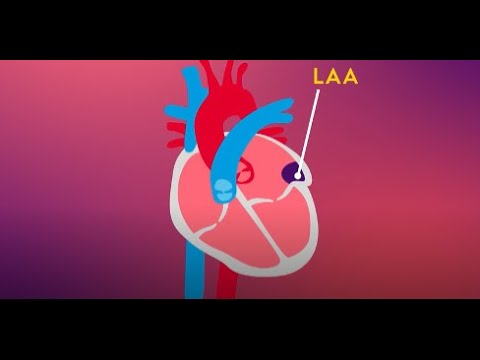 Learn About Atrial Fibrillation (AFib) and Ischemic Stroke Prevention with the LAAO Procedure [Video]