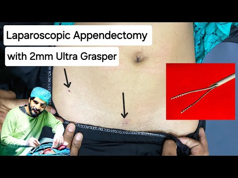 Laparoscopic Appendectomy with 2mm Ultra Grasper – Dr Tayyab Riaz Ch [Video]