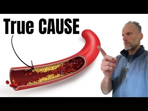 True Causes of Atherosclerosis and Cardiovascular Disease [Video]