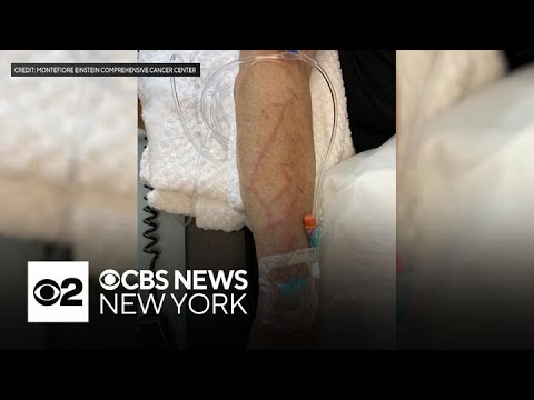 Montefiore in the Bronx has a solution to chemotherapy allergic reactions [Video]