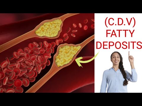 “Top High Cholesterol Foods to Avoid for a Healthy Heart” [Video]