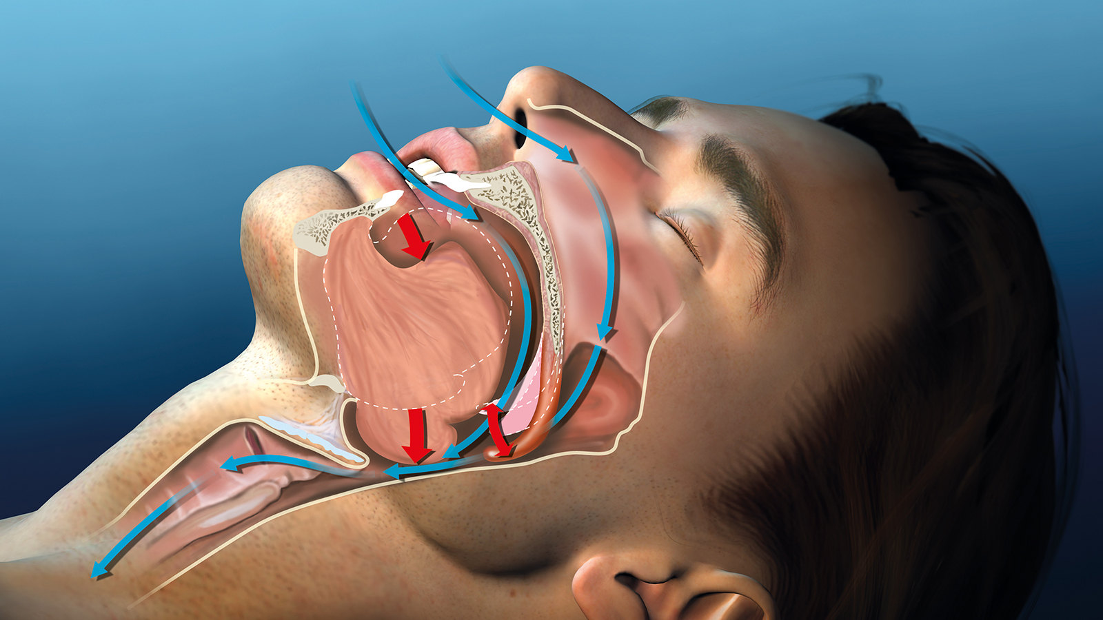23 Causes of Snoring (and How to Stop) [Video]