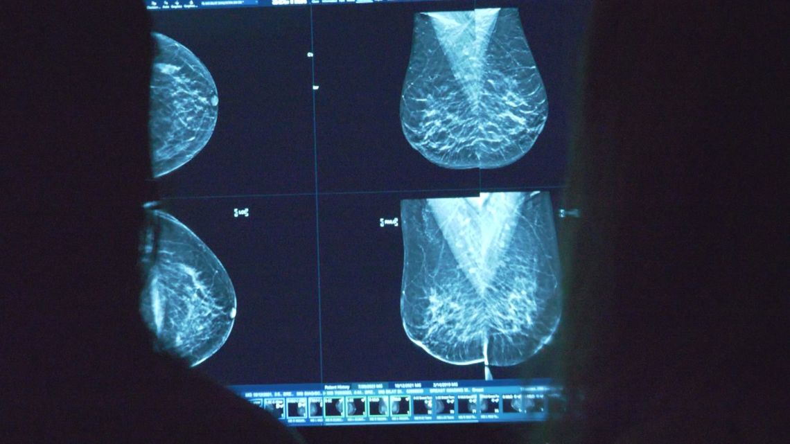 Komen patient navigators help newly-diagnosed breast cancer patients understand the disease, treatment [Video]