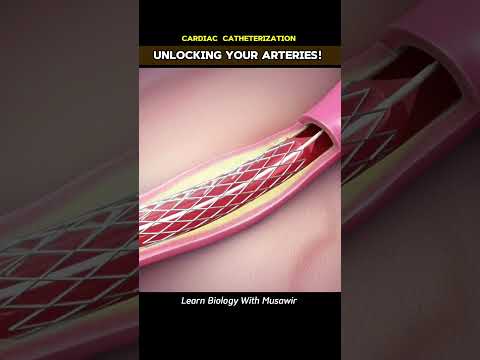 unlocking Your Arteries! Cardiac Catheterization [Video]