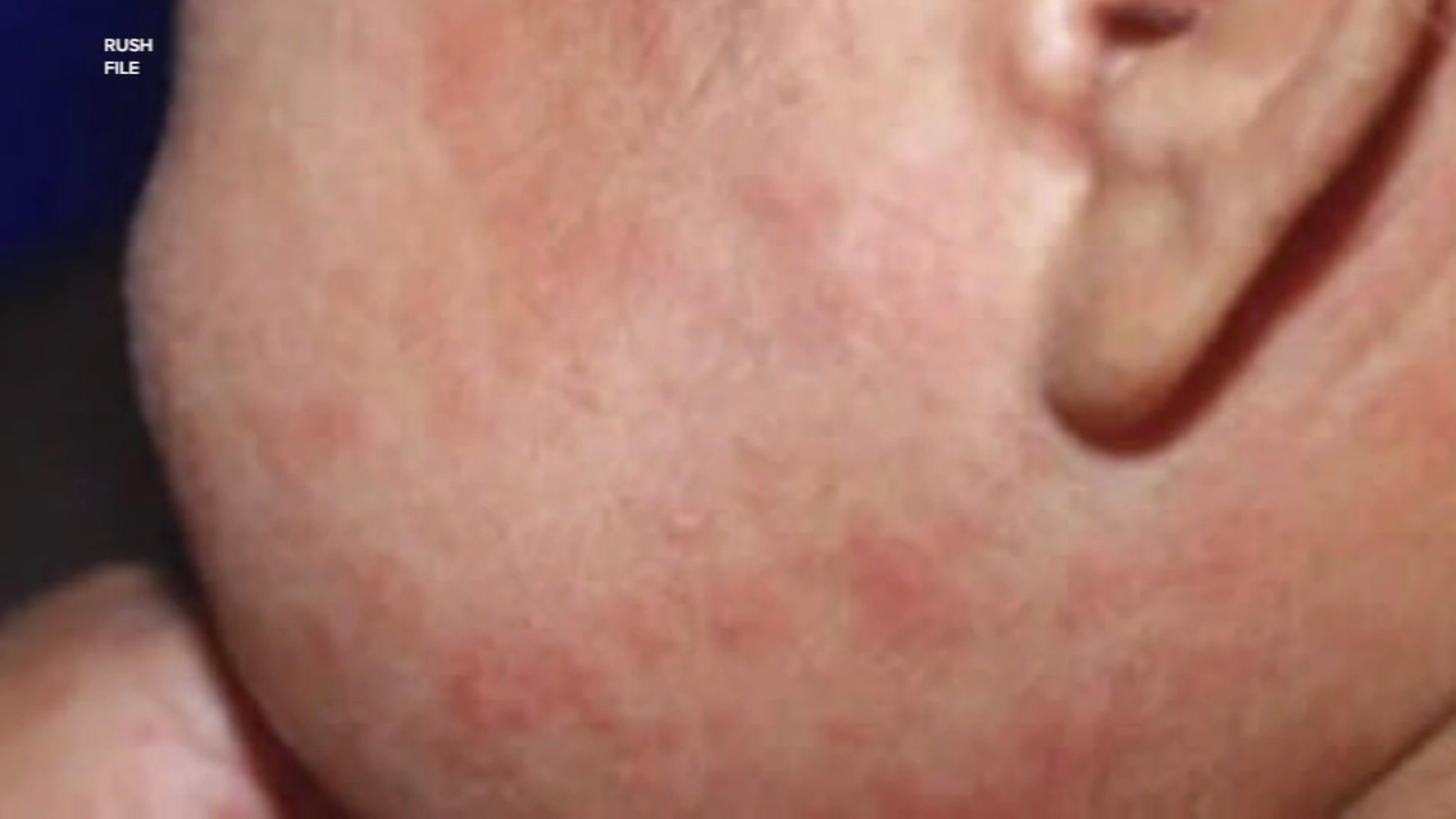 Measles outbreak Chicago: 1st measles case confirmed in suburban Cook County, Illinois as city’s total rises to 52 [Video]