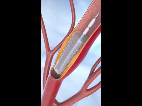 Coronary angioplasty and stent placement. | Animation| Cardiology| [Video]