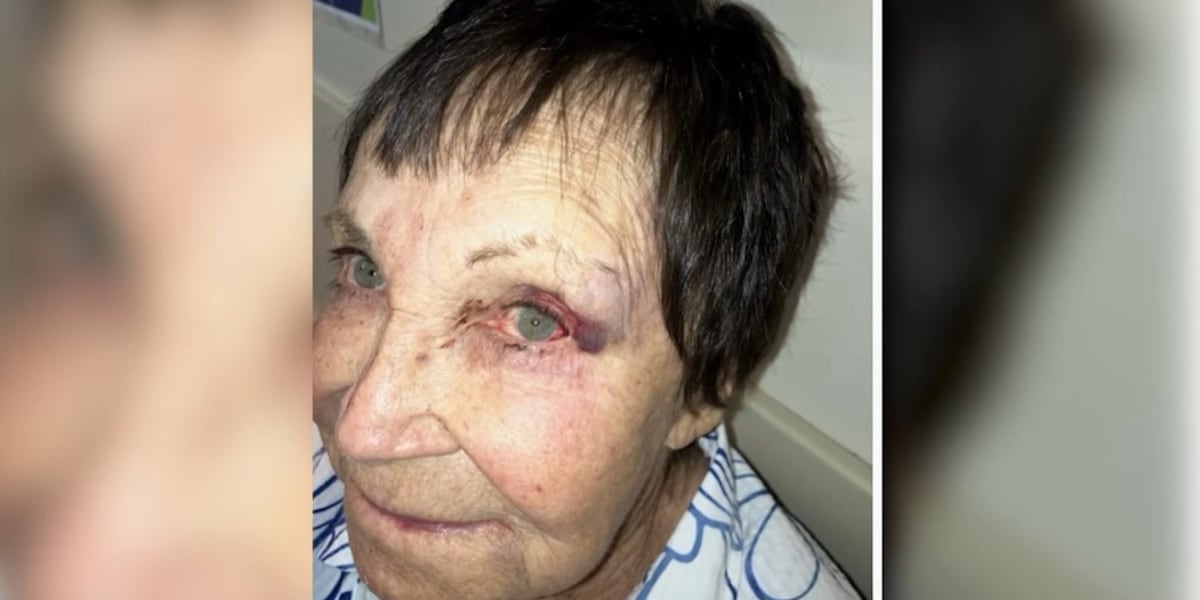 89-year-old comedian feared she would lose her eye after she was sucker-punched [Video]