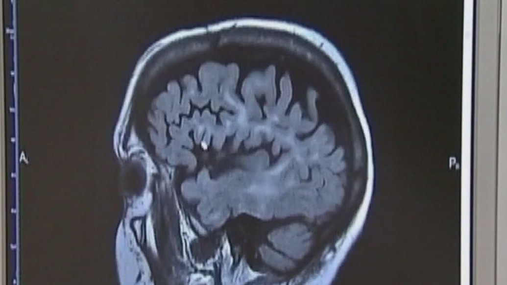 Doctors seeing more stroke patients under 65 [Video]