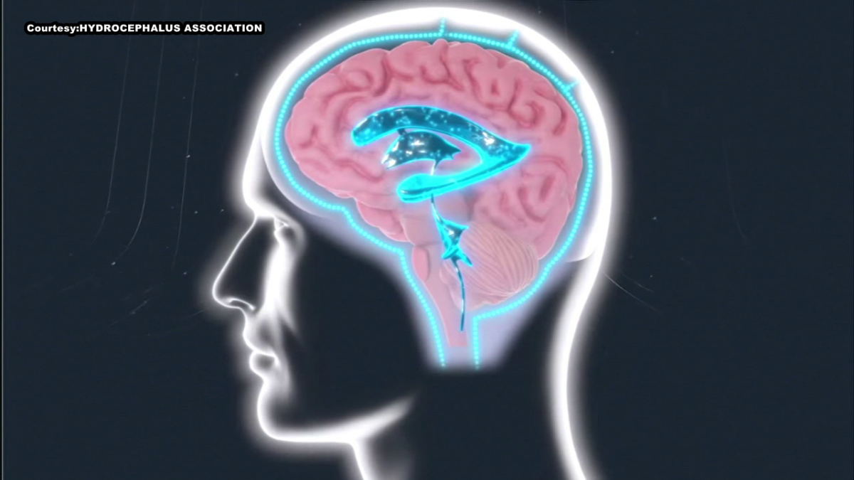 Doctors learning how AI can detect hydrocephalus, other diseases at Tampa conference [Video]